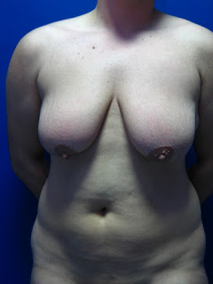 breast removal surgery photos