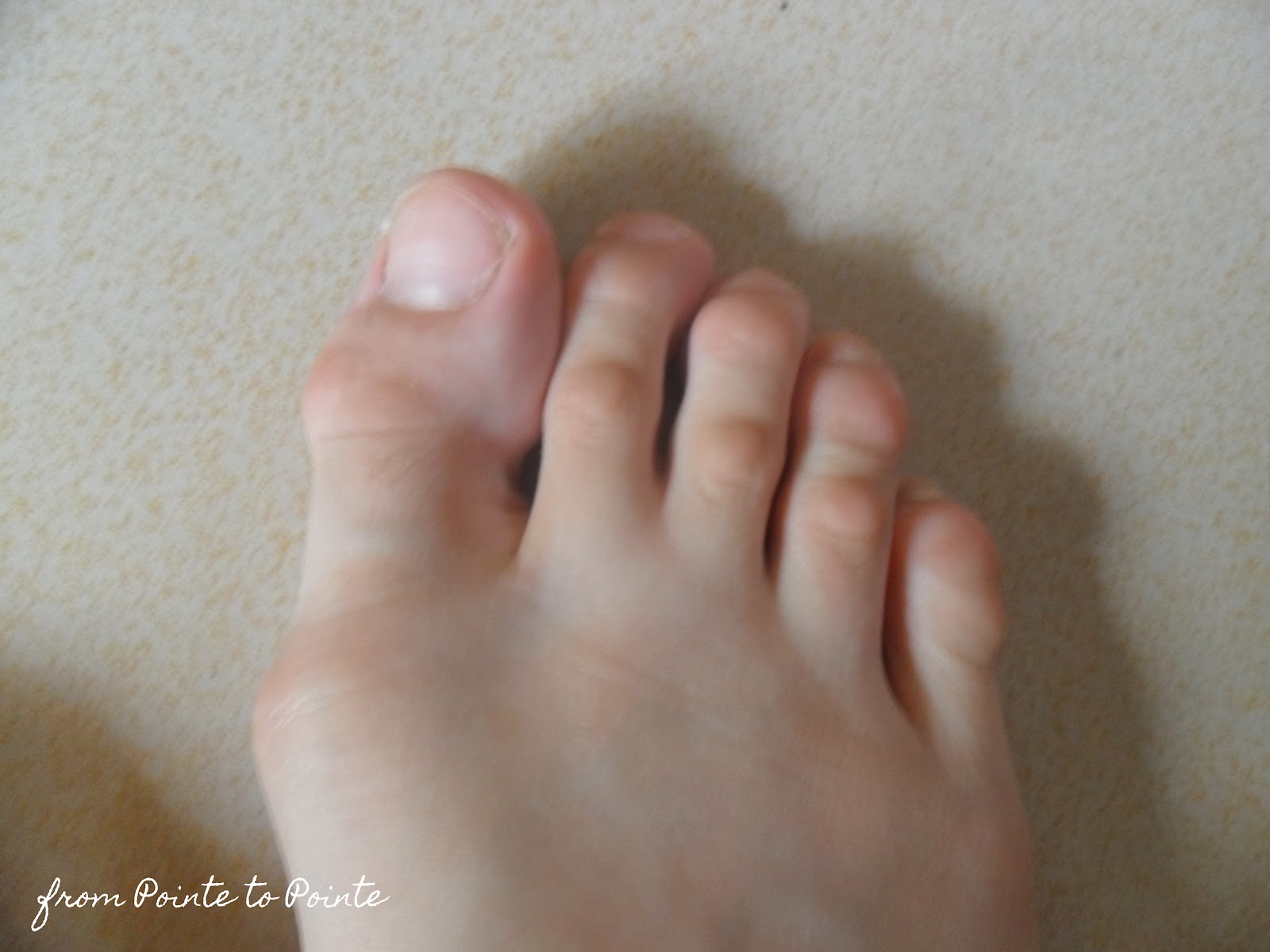 Hammertoe