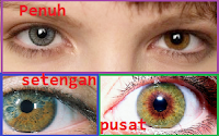 heterochromia