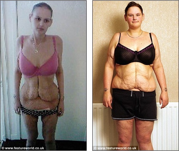 Diet Before And After Weight Loss Surgery