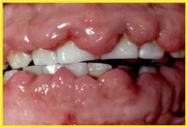 gingival overgrowth
