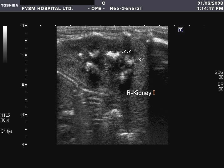 ON RADIOLOGY Ultrasound images of Nephrocalcinosis in neonates