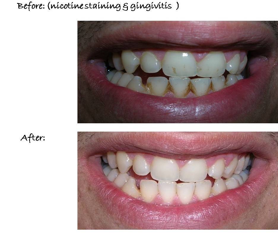 Paphos Dentist, Dr Elena Demetriou Treatment Examples