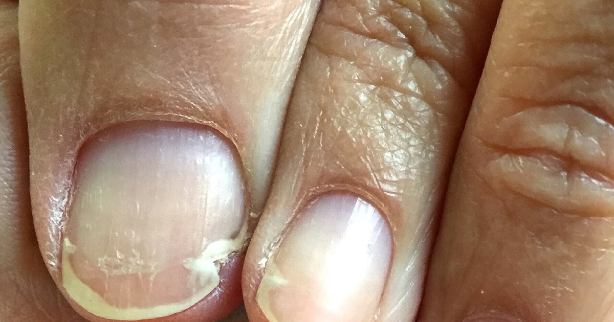 Thanks for the Mammories.... Chemo Was Mean To My Nails