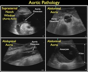 Aaa San Antonio >> RUSH protocol: Rapid Ultrasound for Shock and Hypotension Aaa San Antonio >> RUSH protocol: Rapid Ultrasound for Shock and Hypotension