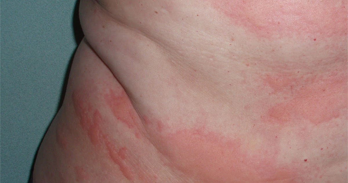 Allergic Reaction Rash On Face And Neck The Way To Avoid