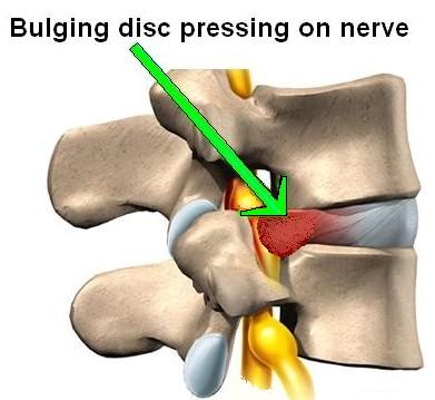 Epidural steroid injection herniated disc neck