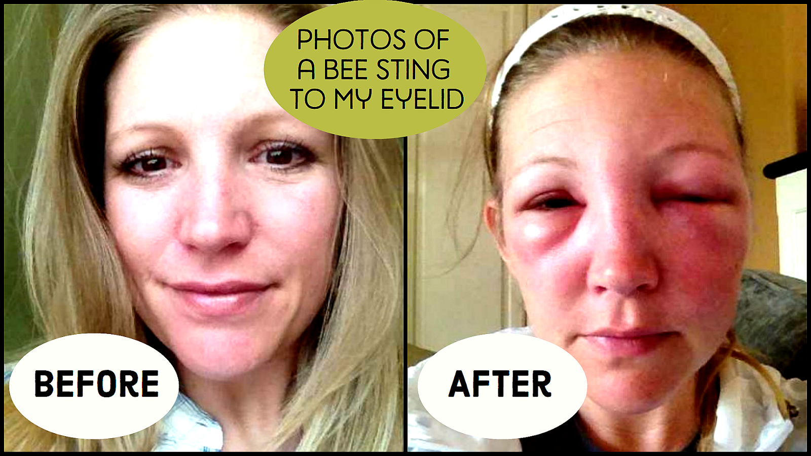 hornet bee sting treatment hornet bee sting treatment