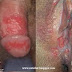 Pengobatan Tradisional Herpes Kelamin Paling Mujarab thumbnail