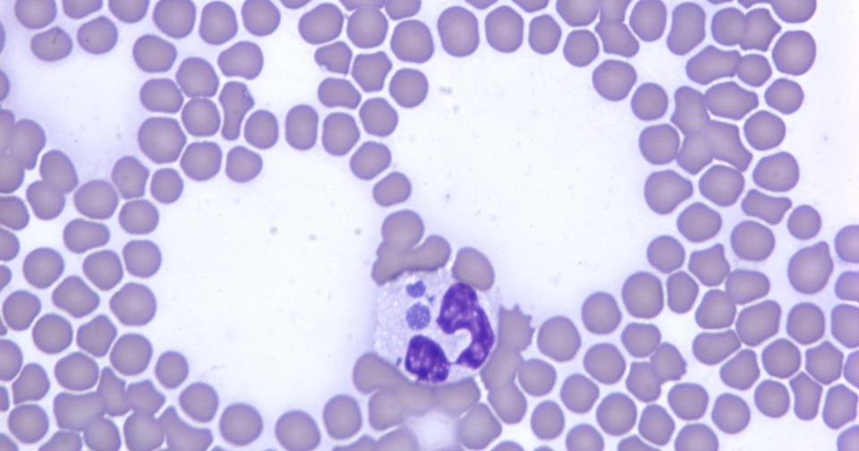 VETERINARY HEMATOLOGY DEXTERVET Morulae of Anaplasma phagocytophilum inside a neutrophil this