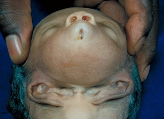 Baby Born With Ears Under Its Chin