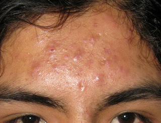 sudor no limpia los poros sudor y acne