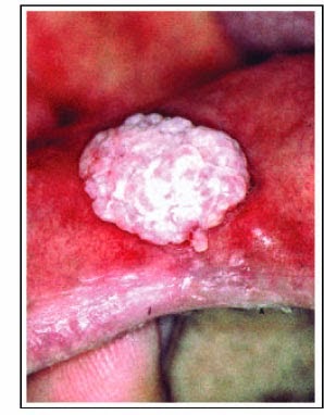HPV BUCAL hpv bucal: