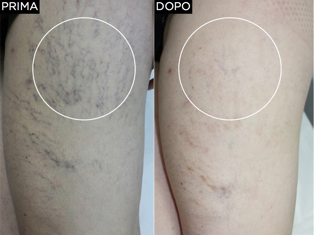 Tintura per gambe da varicosity