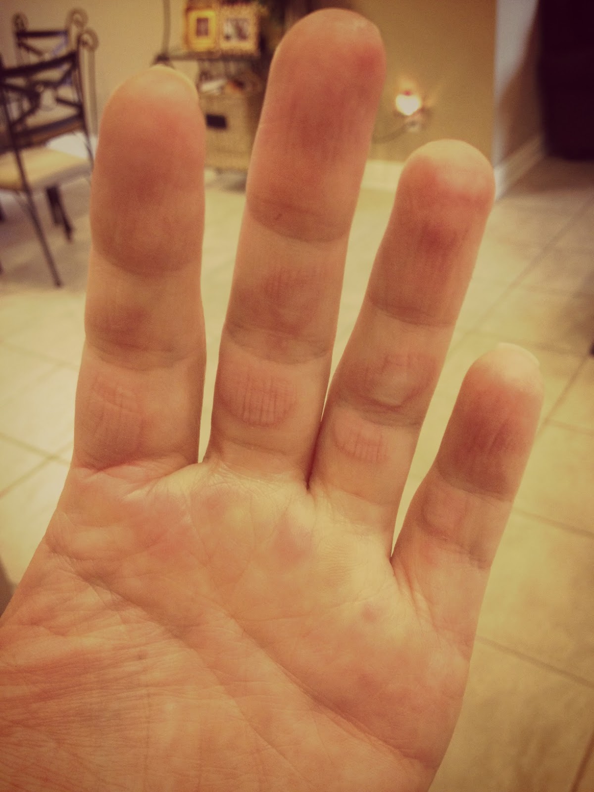 What To Put On My Burn Finger at Anna Saxton blog