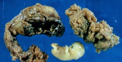 weeks miscarriage gestation fetus