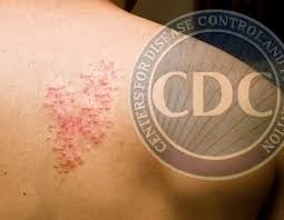 Shingles vaccine after steroids