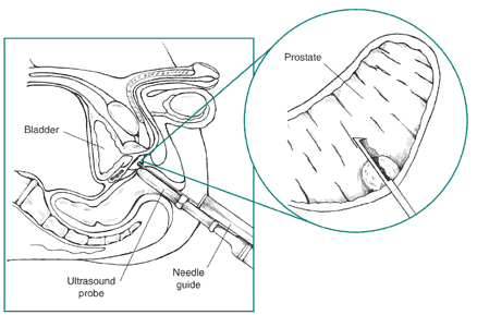 Prostate Biopsy