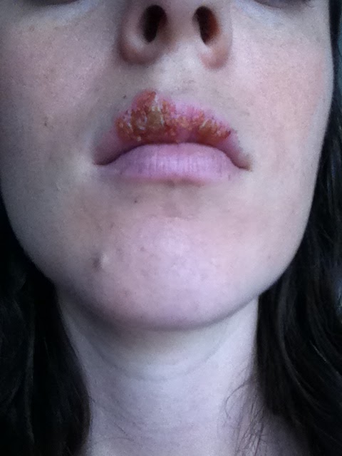 Scab Lip