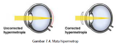 Mata hipermetrop (rabun dekat)