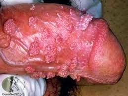 Apa Obat Untuk Kutil Kelamin Pria Apa Obat Untuk Kutil Kelamin Pria