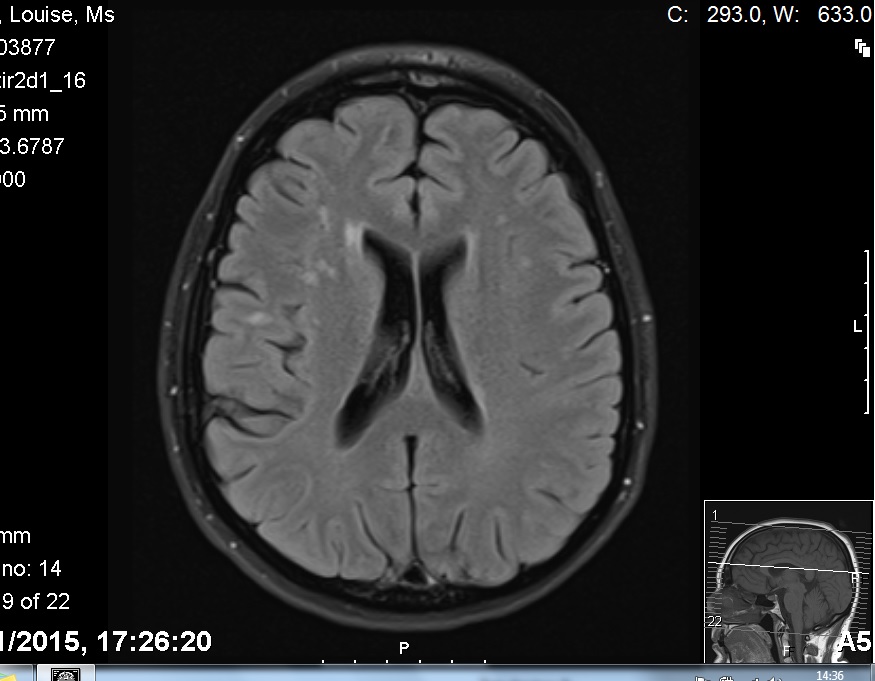 This is a recent scan of my brain, I add my head circumference is very small