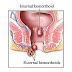 Obat Ambeien Kapsul thumbnail