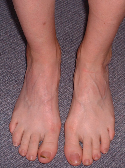 Health, Fitness Naturally! Cortisone Injections