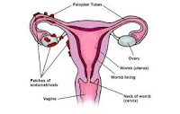 Pengobatan Herbal Untuk Endometriosis