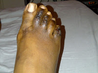 Hammer Toe