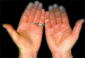 Pinky And Ring Finger Numb When Sleeping Pinky And Ring Finger Numb When Sleeping