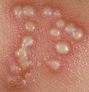Foto Mengatasi herpes berair yang perih