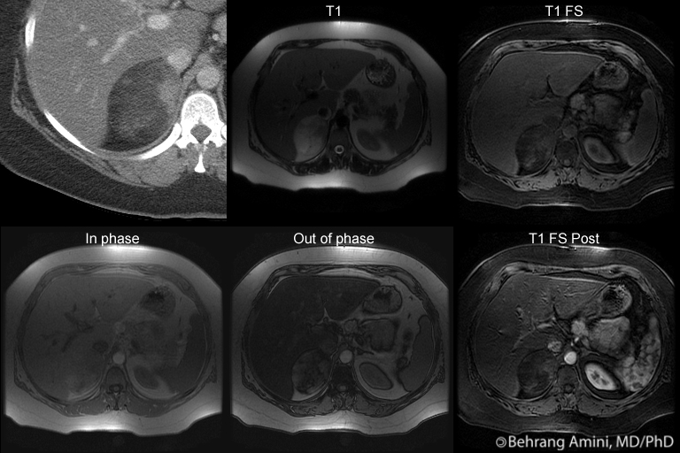 Adrenal Myelolipoma Ct
