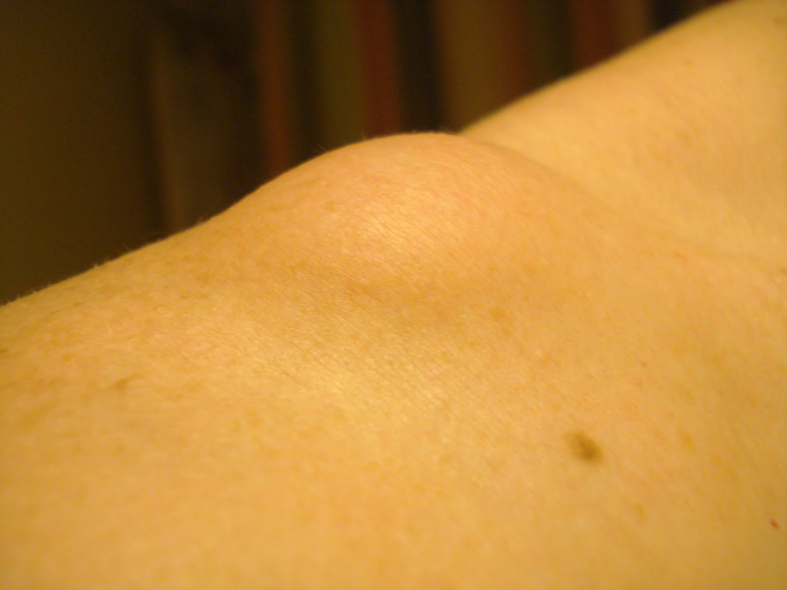 What Is This Bump On My Shoulder Medical Subcutaneous Bumps Ask