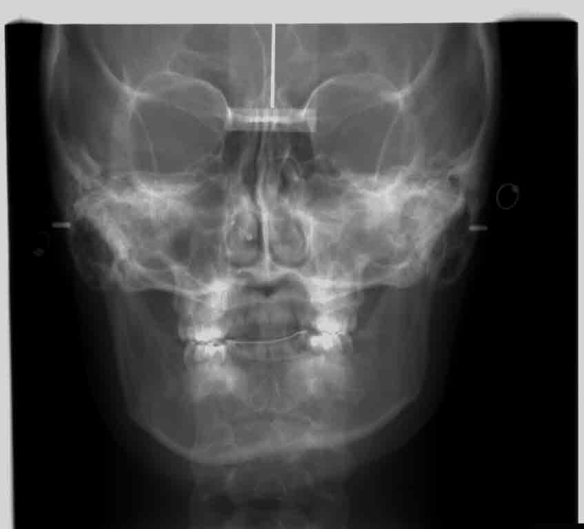 my crooked jaw i got issues, ya'll