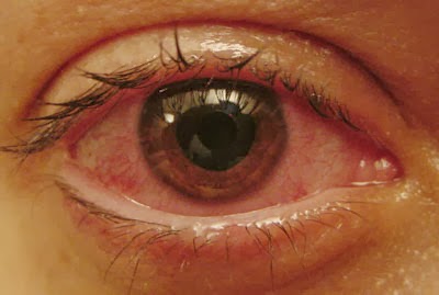 Steroid eye drops blurry vision