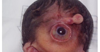 TYWKIWDBI ("Tai-Wiki-Widbee"): Cyclops