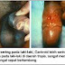 Obat untuk sakit sipilis thumbnail