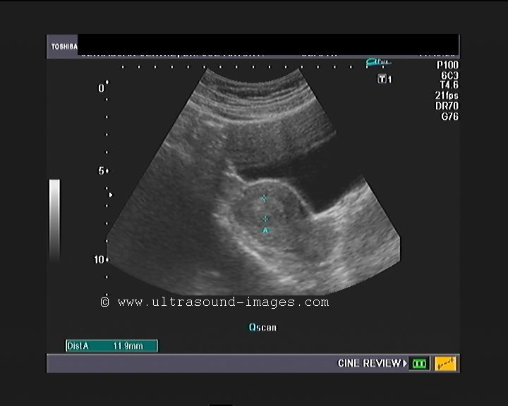 Get Adnexal Mass Images