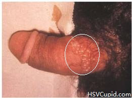Male Genital Herpes Photo