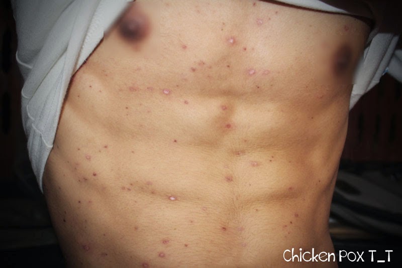 chicken pox mix n