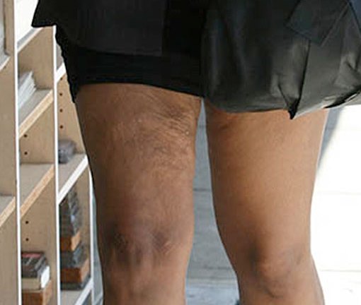 Excess Skin Legs After Weight Loss