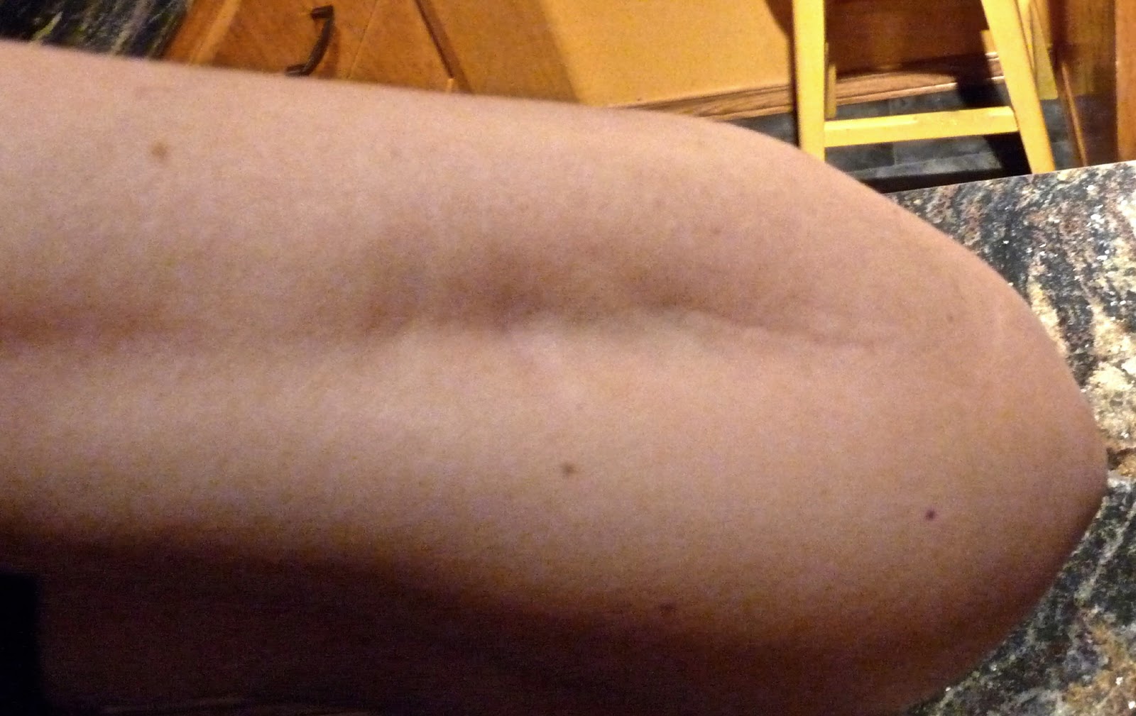 faiblesse musculaire bras