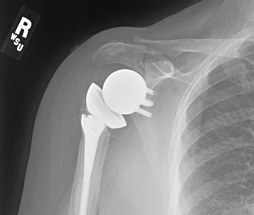 impacted shoulder fracture impacted shoulder fracture