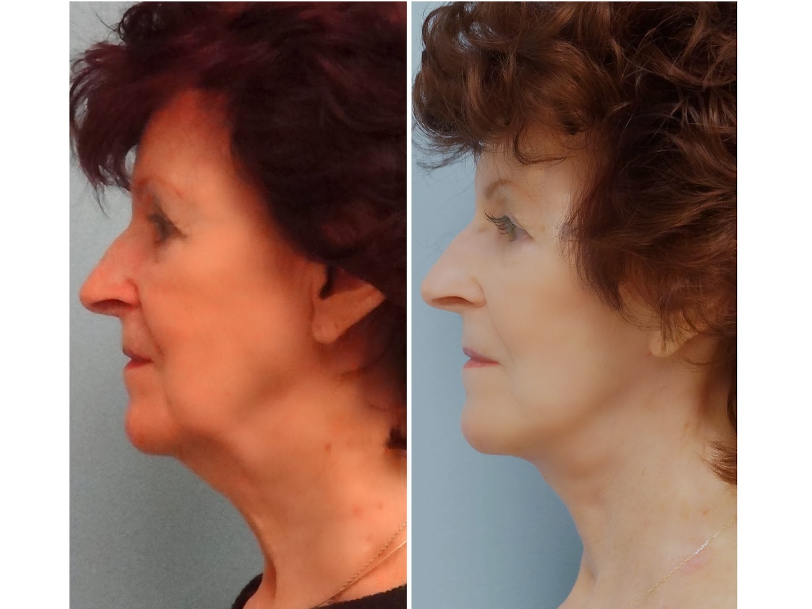 Facial Plastic Surgery Facelift, Necklift, Platysmaplasty, ERBYAG