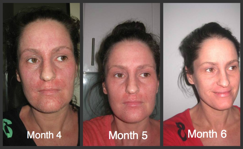 Topical Steroid Withdrawal JourneyHealing Eczema and Red Skin Syndrome