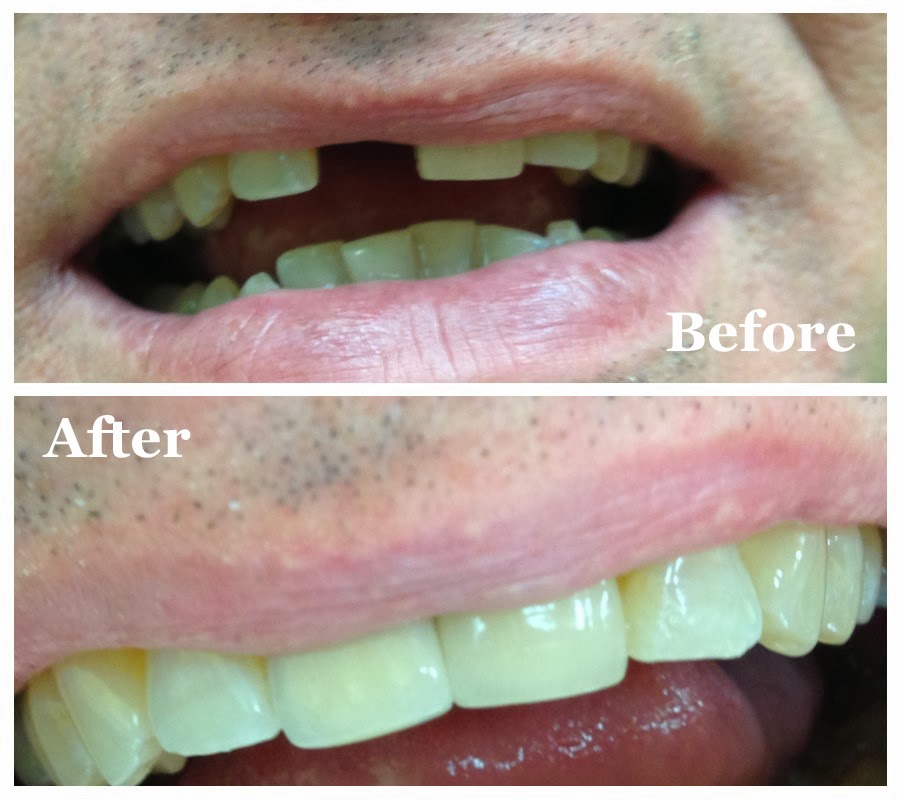 Dr. Elizabeth Dimovski and Associates Dentists Brampton Single Tooth