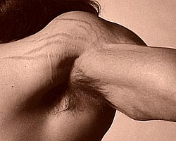 Muscle_Stretch_Marks.jpg