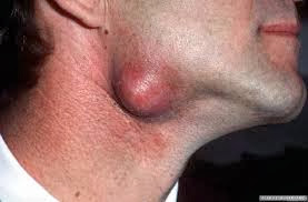 Pictures of Sebaceous Cyst