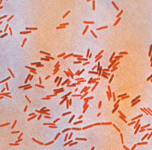 Typhoid Fever Pictures